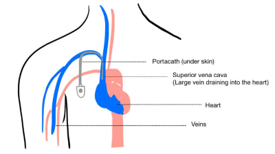 A diagram showing where the portacath is inserted on the body