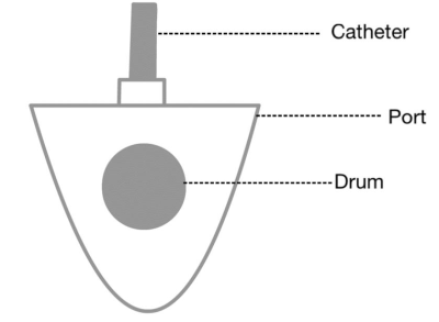 Diagram of a portacath